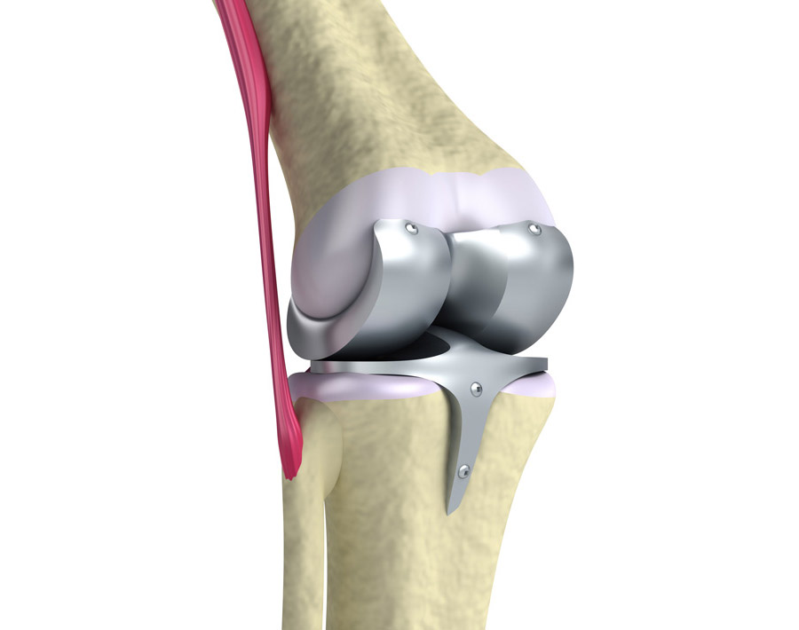 Эндопротезирование коленного сустава картинки